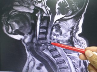 Radiografia del rachide cervicale