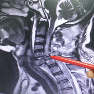 Radiografia del rachide cervicale