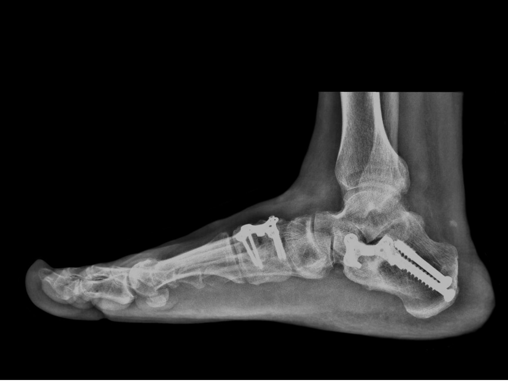 La radiografia di un piede