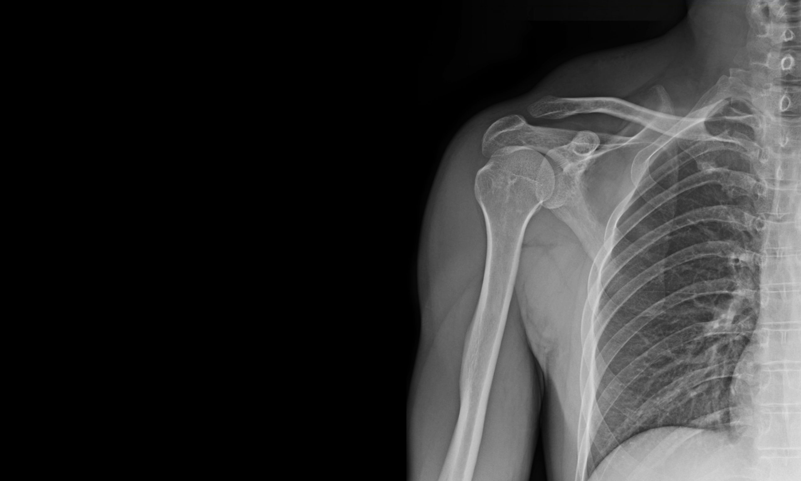 Immagine di una radiografia della spalla